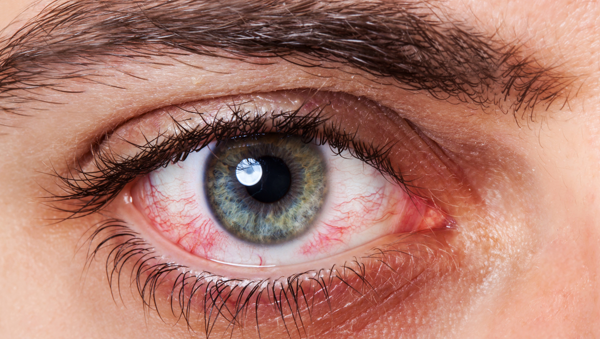 Itchy, red and dry eyes are a common cannabis allergy symptom.