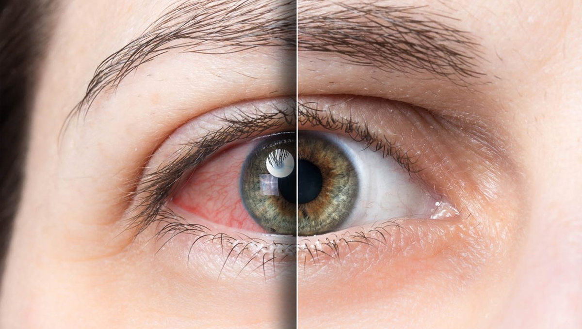 The vasodilation effect of cannabis