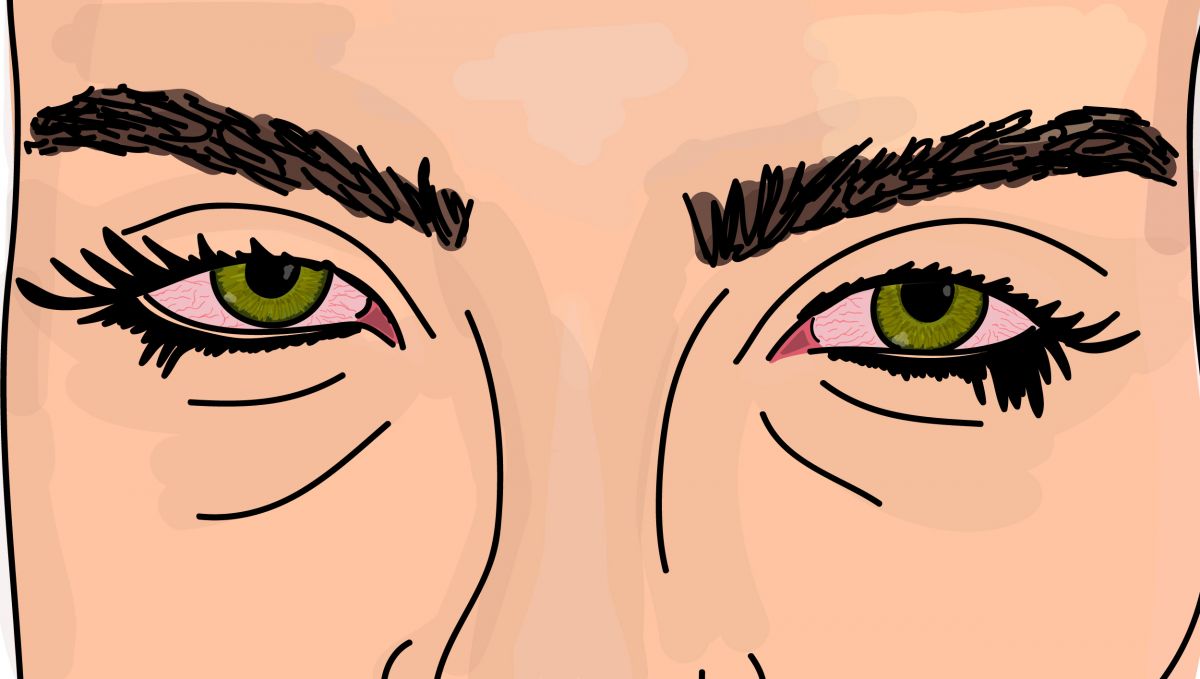 Puffy red stoner eyes